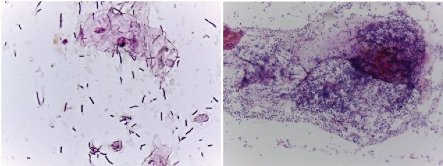 Gram-stained slides for women with and without bacterial vaginosis