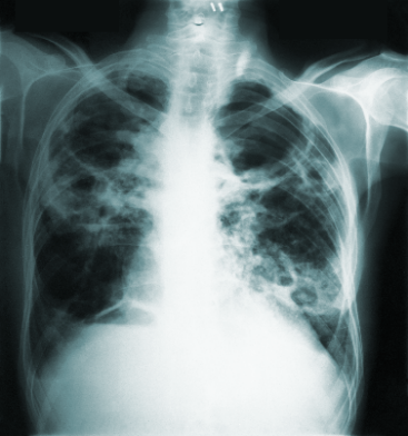 An x-ray image with a black background and a white figure of the torso of a human.